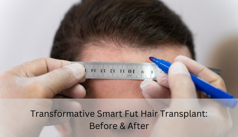 smart fut hair transplant before and after